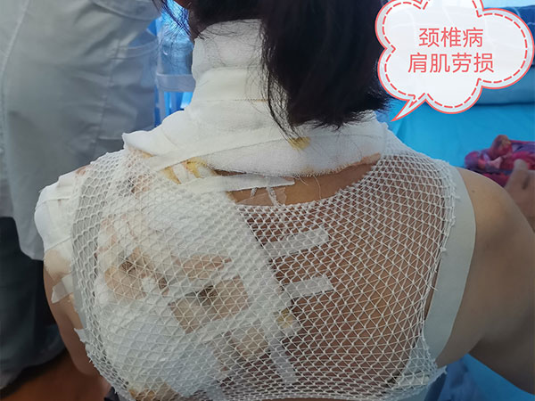 湿敷治疗技术 